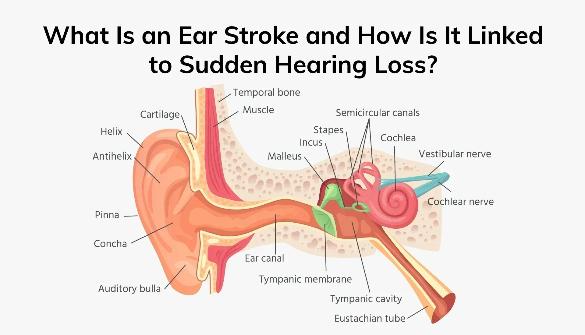 What Is an Ear Stroke and How Is It Linked to Sudden Hearing Loss?
