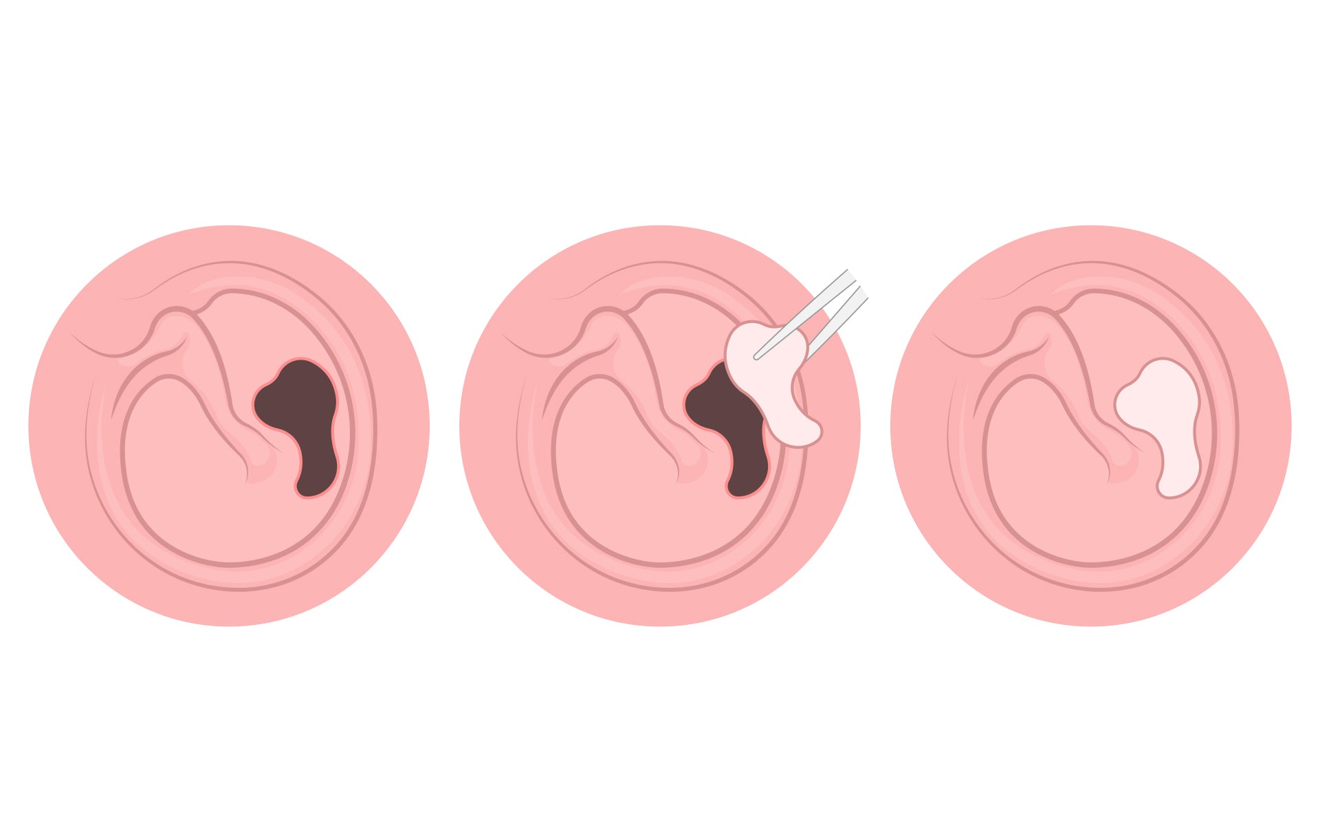 This is what you need to know about perforated eardrum